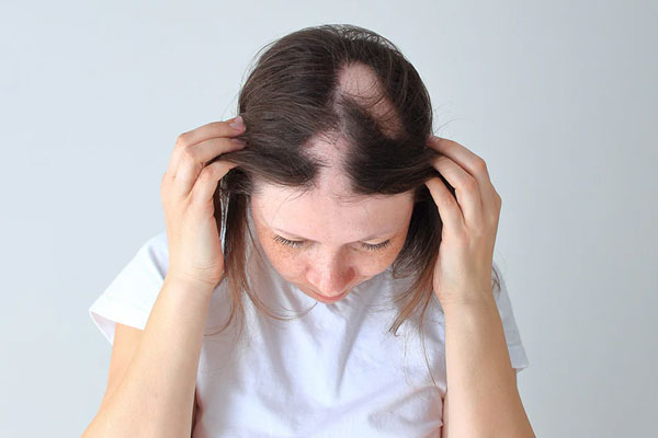 Alopecia Areata (Patch Hair Loss)