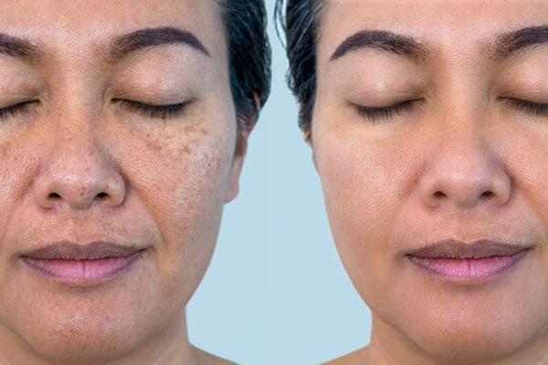 Pigmentation / Melasma