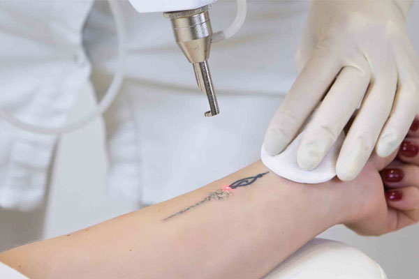 Laser Tattoo Removal