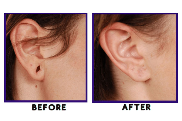 Ear Lobe Repair